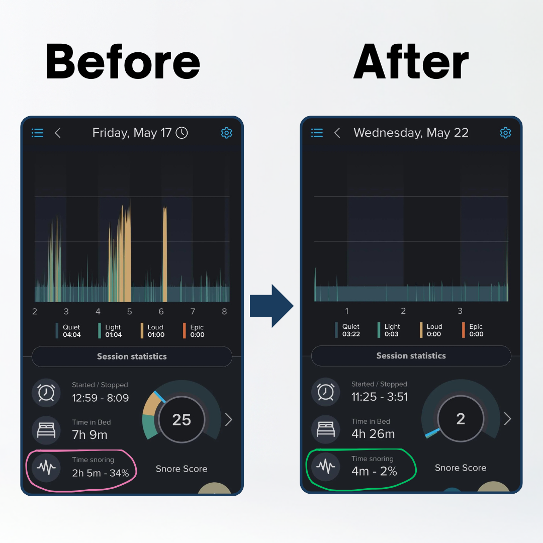 Two sleep-tracking app screenshots side by side showing a large reduction in recorded snoring time